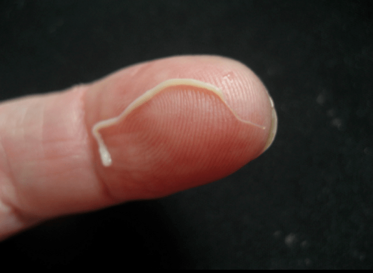 Roundworm parasite mula sa katawan ng tao